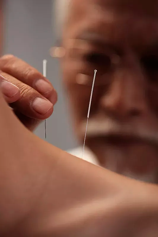Acupuncture treatment